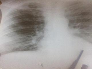 snimak pluća