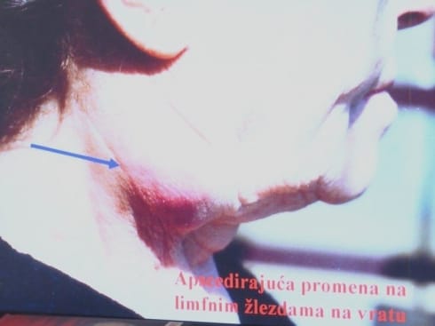 Epidemija zečje groznice u merošinskom selu 15 490x370 800x600 tularemija