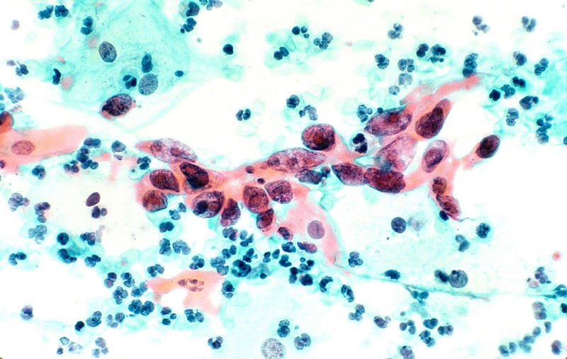 800px Squamous cell carcinoma in the cervix pap stain
