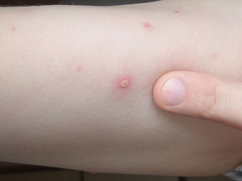 Epidemija "ovjih boginja" u vrtiu preminule devojice - Drutvo - June  vesti
