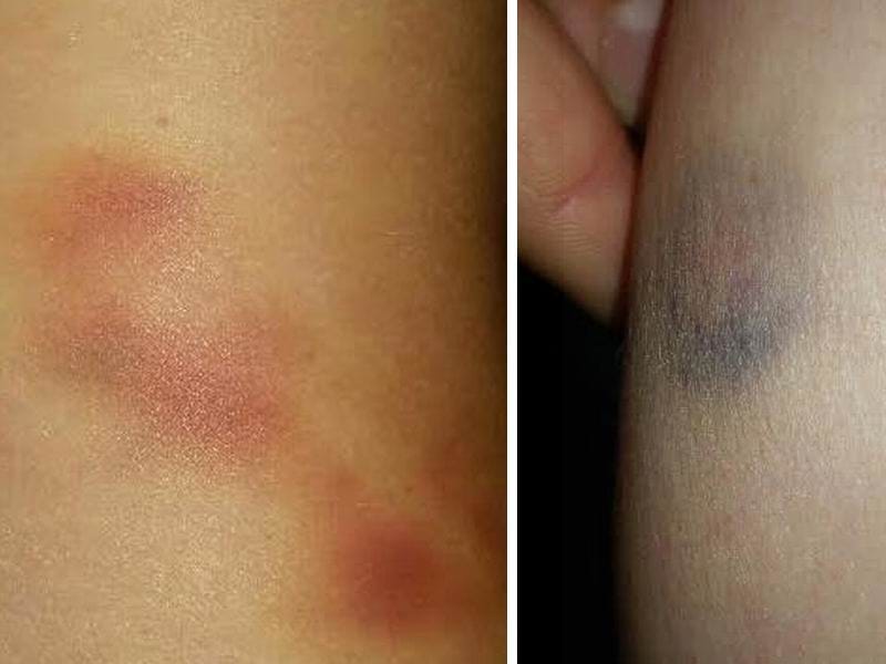 Modrice vidljive i telima oba supriznika foto D M