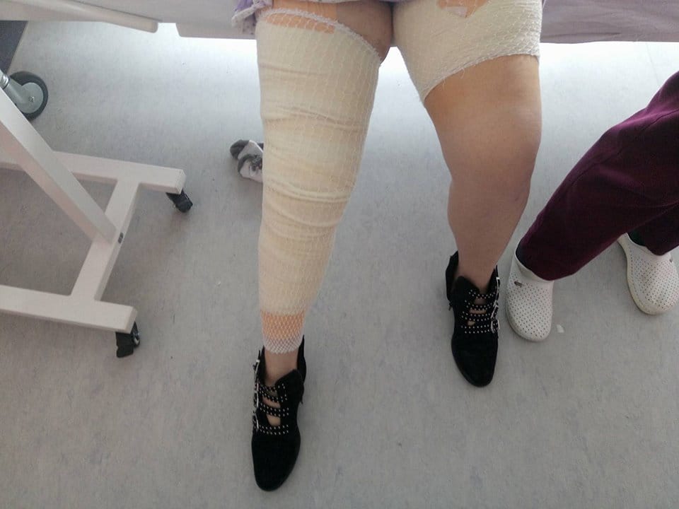 Pacijentkinji u novom Kliničkom centru tokom operacije žuči gorela noga 1 Izgorela noga u zavoju foto V Milic