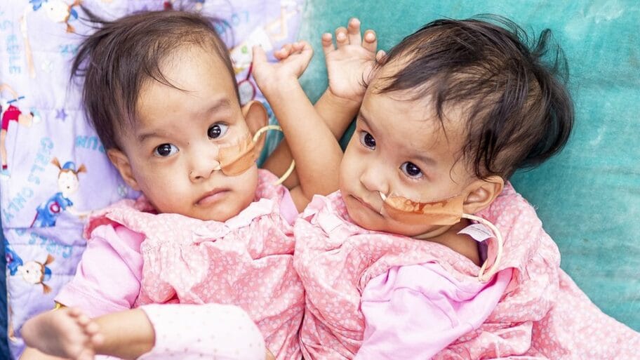 Sijamske bliznakinje: Devojčice razdvojene posle šestočasovne operacije 15 104238288 1b817dc4 98e3 44ed b946 3f1339cc4c88