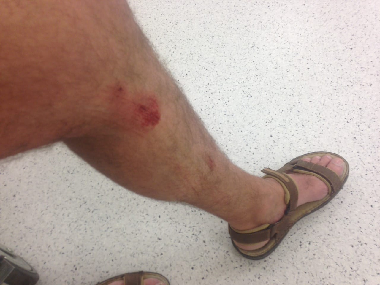 Povrede od upada u sahtu foto S P