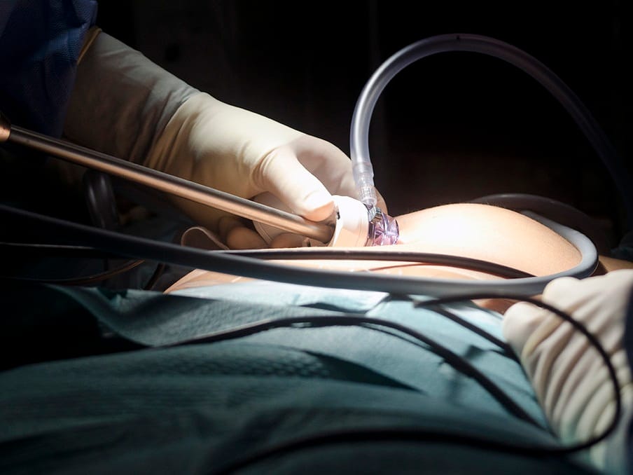 Laparoskopija ilutsracija foto flickr Elisa Trigo