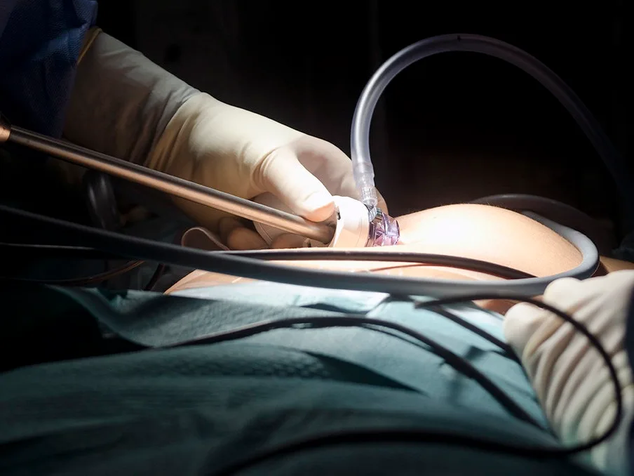 Laparoskopija ilutsracija foto flickr Elisa Trigo