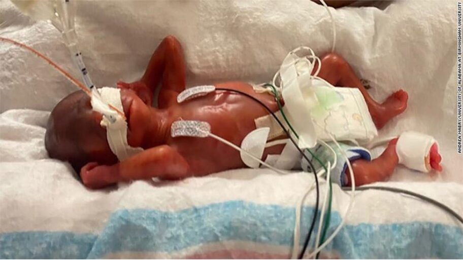 121516748 211110175553 02 most premature baby exlarge 169