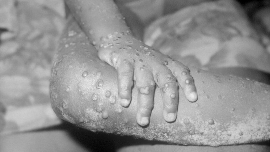 103585163 monkeypox getty