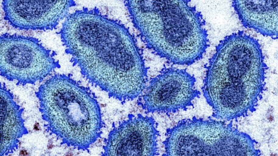 125282139 monkeypox spl