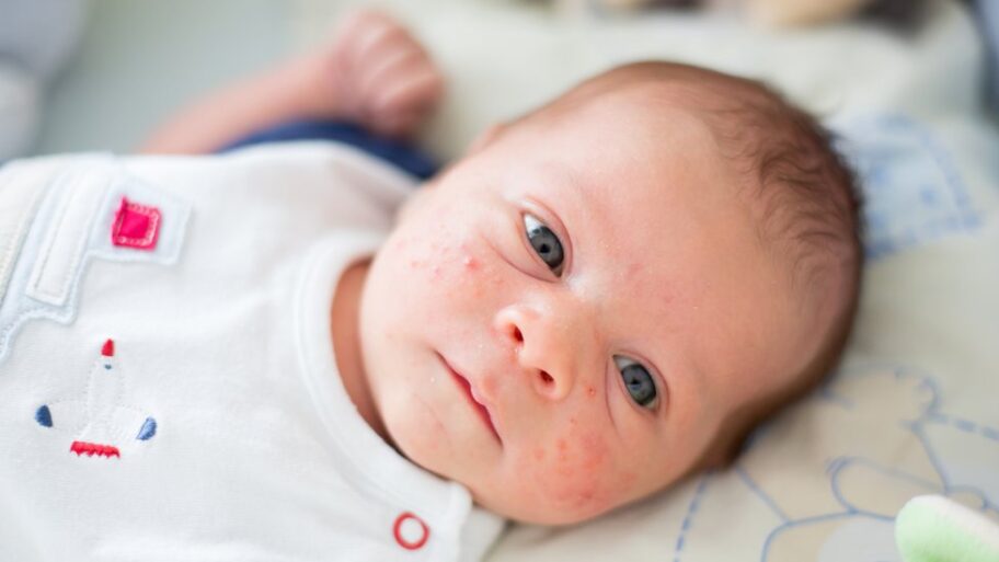 Bebe i zdravlje: Lepljiva traka može predvideti ekcem kod dece 20 126608957 gettyimages 1036030724