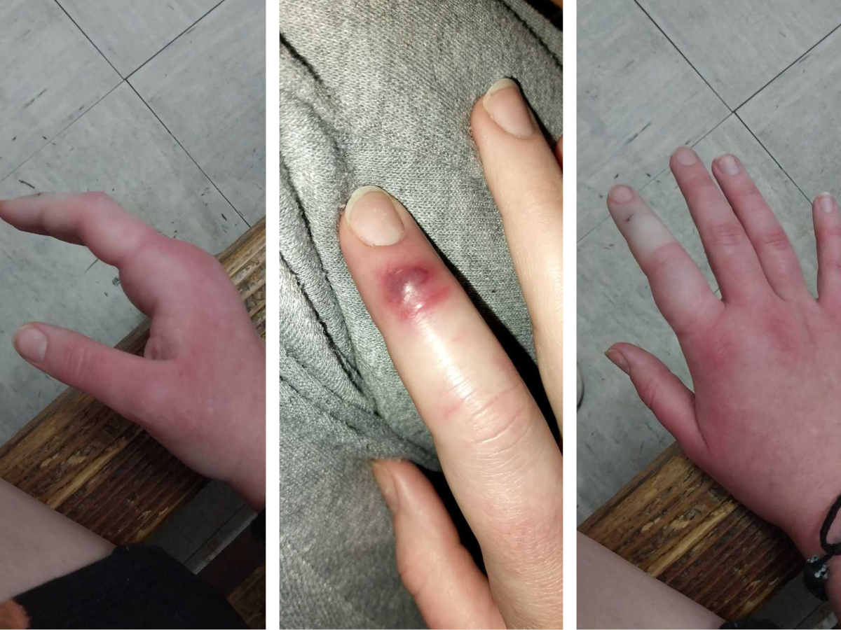 Ujed zmije foto Isidora Milenkovic