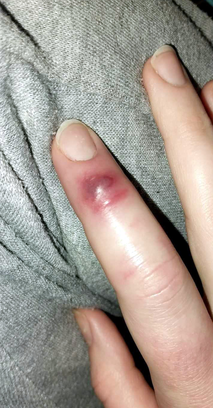 Ujed zmije3; foto: Isidora Milenković.jpeg.jpg.jpg