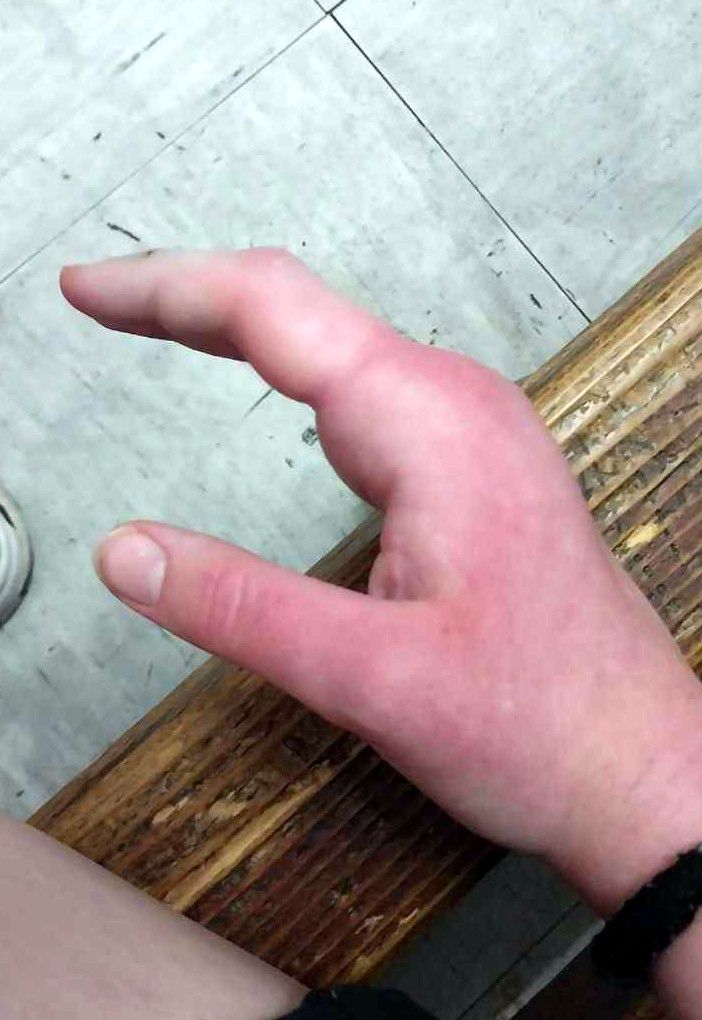 Ujed zmije2; foto: Isidora Milenković.jpeg.jpg