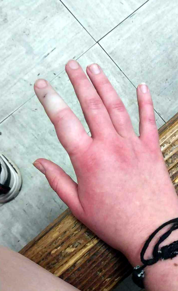 Ujed zmije1; foto: Isidora Milenković.jpeg