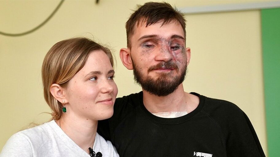 Rusija i Ukrajina: Rat stvorio armiju amputiranih, pravu pokretnu traku slomljenih tela 13 131252191 andriiandalina2gk