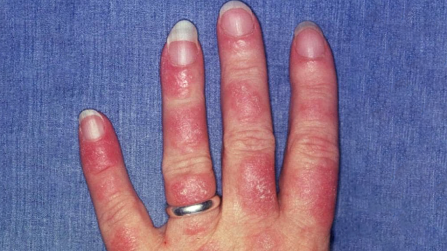 133291440 00lupuscover