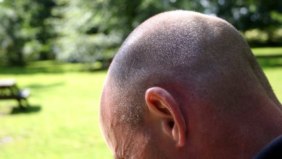 Zdravlje: „Svima pričam da sam presadila kosu" 6 133011060 7037723b 3959 4582 b6f3 c9422d11cb6e